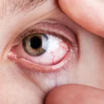 Cara Mengatasi Mata Kering dengan Kompres Hangat Menurut Dokter