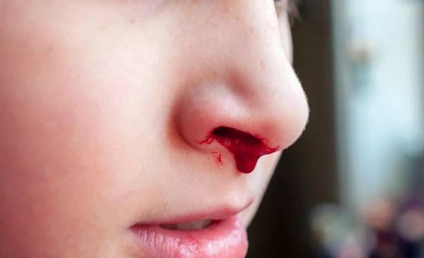 Riwayat Alergi Mungkin Jadi Pemicu Mimisan Berulang pada Anak