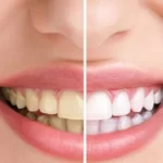 Tips Praktis Memutihkan Gigi Menggunakan Bahan Dapur