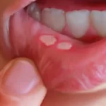 Waspadai Sariawan yang Tidak Segera Sembuh
