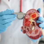 Meninggal Akibat Gagal Ginjal karena Minum Kopi Setiap Hari, Ini Tanggapan Dokter