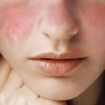 Penyebab Anak Perempuan Lebih Rentan Terkena Lupus Daripada Laki-Laki