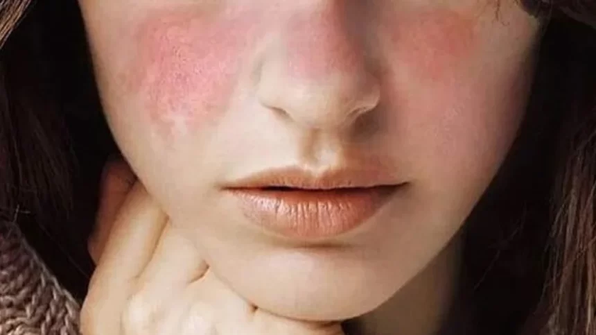 Penyebab Anak Perempuan Lebih Rentan Terkena Lupus Daripada Laki-Laki